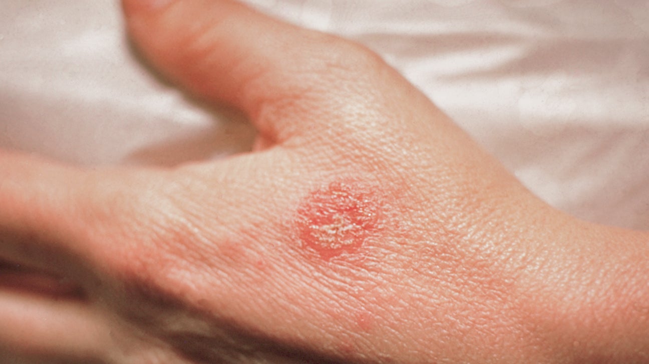 Nummular Eczema: Causes and How to Get Rid of It