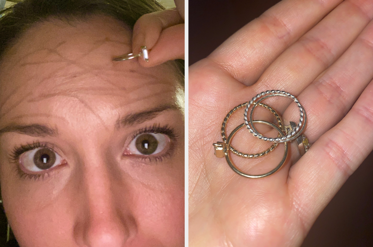 The Gold Ring Test on Cheek for Iron Deficiency | Healthfully